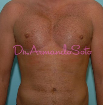 Pectoral Implants for Men
