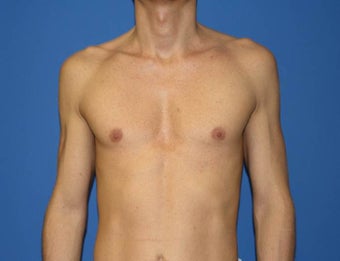Pectoral Implants, Chest Augmentation