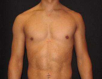 Pectoral Implants