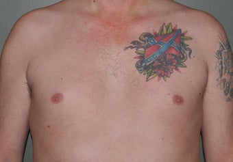 Pec Implants