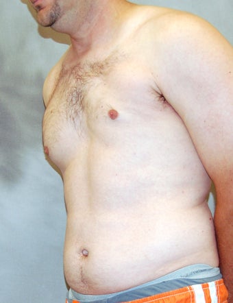 Male Chest Enhancement