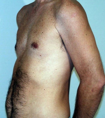 Male Chest Enhancement