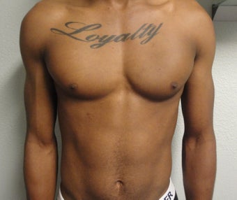 Pectoral Implants