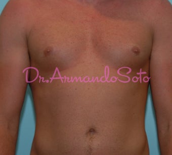 Pectoral Implants for Men