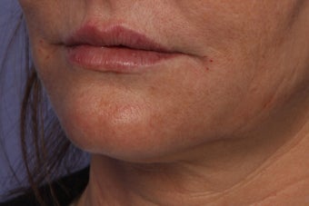 Perlane L to Lips
