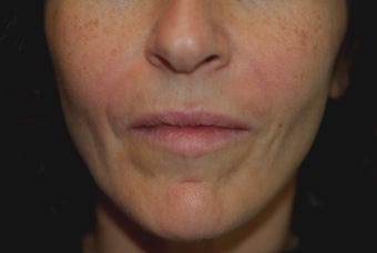 Perlane Injections
