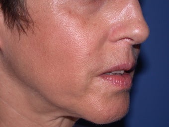 Before & After Perlane to the nasolabial folds