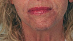 Perlane Treatment for laugh lines