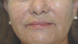 Perlane and Botox for mouth lines