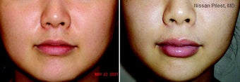 Lip Augmentation with Perlane