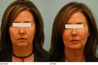 Injectable Fillers (Restylane/Perlane)