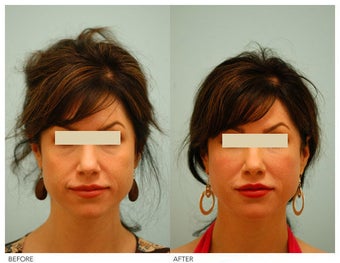 Injectable Fillers (Restylane/Perlane)