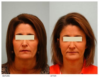 Injectable Fillers (Restylane/Perlane)