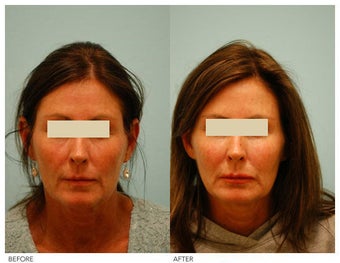 Injectable Fillers (Restylane/Perlane)