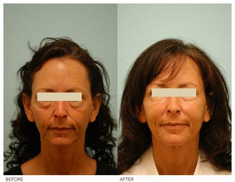 Injectable Fillers (Restylane/Perlane)