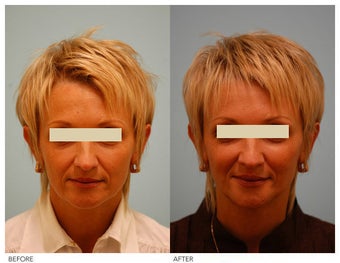 Injectable Fillers (Restylane/Perlane)
