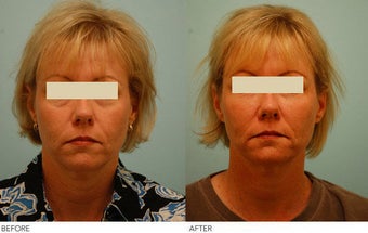 Injectable Fillers (Restylane/Perlane)