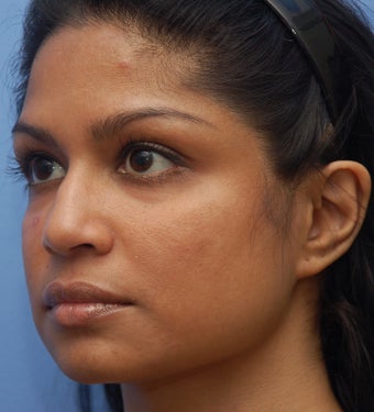 Cheek Dermafillers,Facial Dermafillers,Cheek Enhancement,Eye Dermafillers