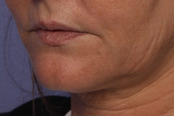 Perlane L to Lips