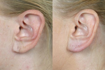 Perlane to Earlobes