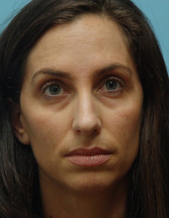 Eye Dermafillers,Cheek Dermafillers,Facial Dermafillers