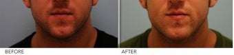 Male Lower Face Enhancement