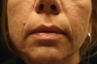 Perlane Injections