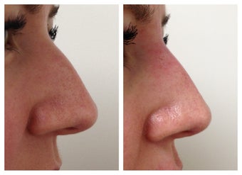 Non-surgical nose job