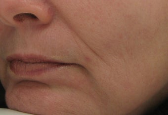 Nasolabial folds and Marionette lines after treatment with Perlane