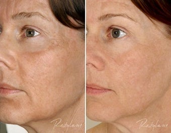 Before and after Restylane Perlane