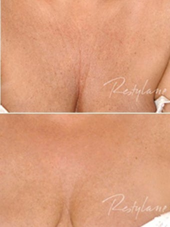 Before and after Restylane Perlane