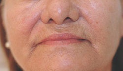 Perlane and Botox for mouth lines
