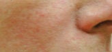 Perlane for cheeks