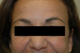 Permanent Makeup Removal Los Angeles Before and After Pictures
