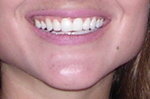 Full Lip