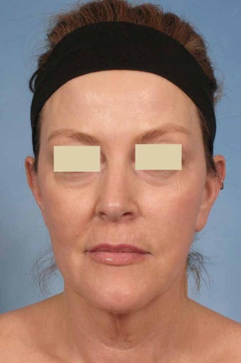 Phenol Peel