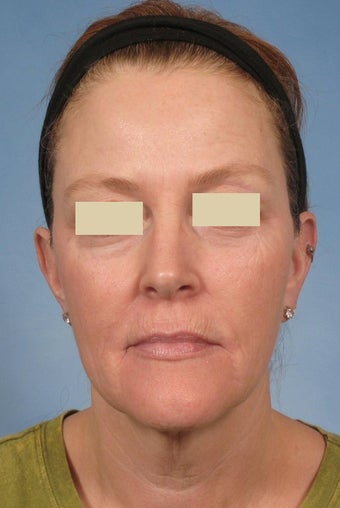 Phenol Peel
