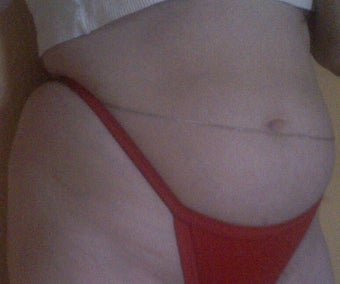 Smart Lipo