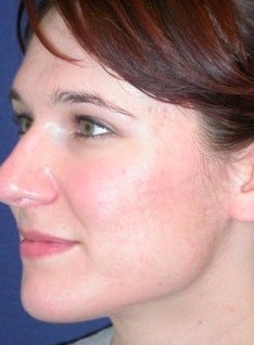 PDT for acne