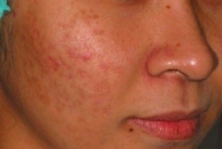 PDT for acne