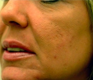 Acne treatment