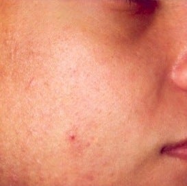 PDT for acne 