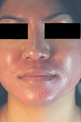 Photodynamic Therapy for Acne