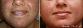 Photo Dynamic Therapy for Acne