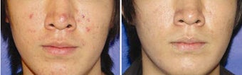 Photo Dynamic Therapy for Acne