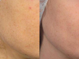 Photodynamic therapy - PDT