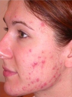 PDT for acne