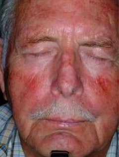 PDT for rosacea
