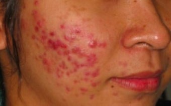 PDT for acne