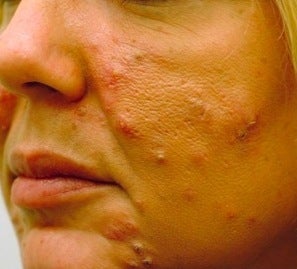 Acne treatment